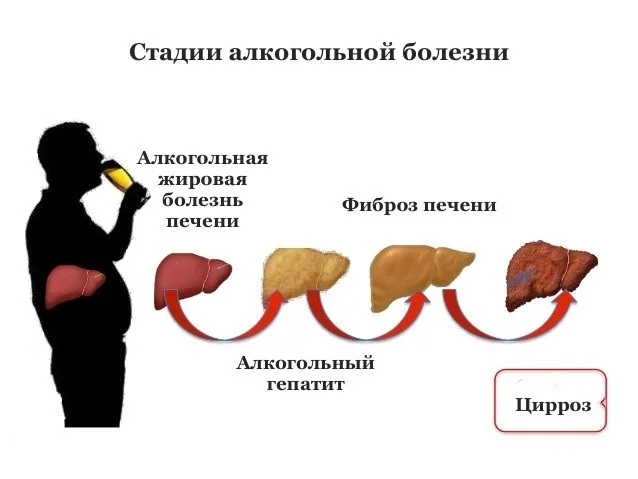 Алкогольный токсический гепатит