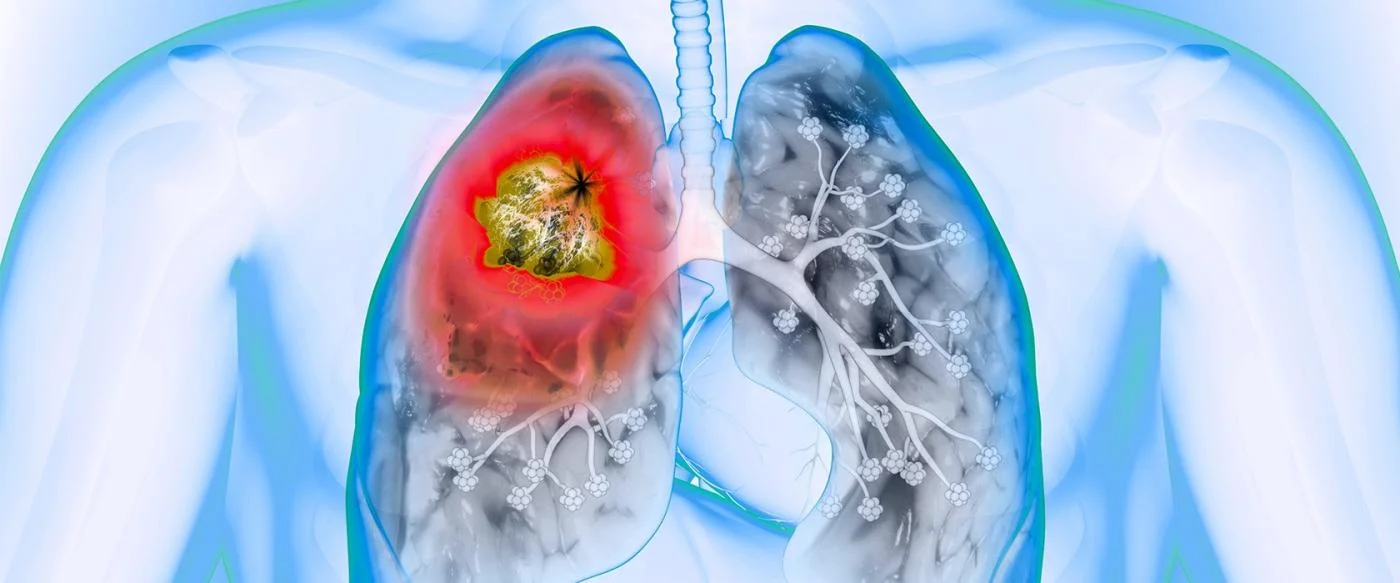 Факторы риска развития рака легких