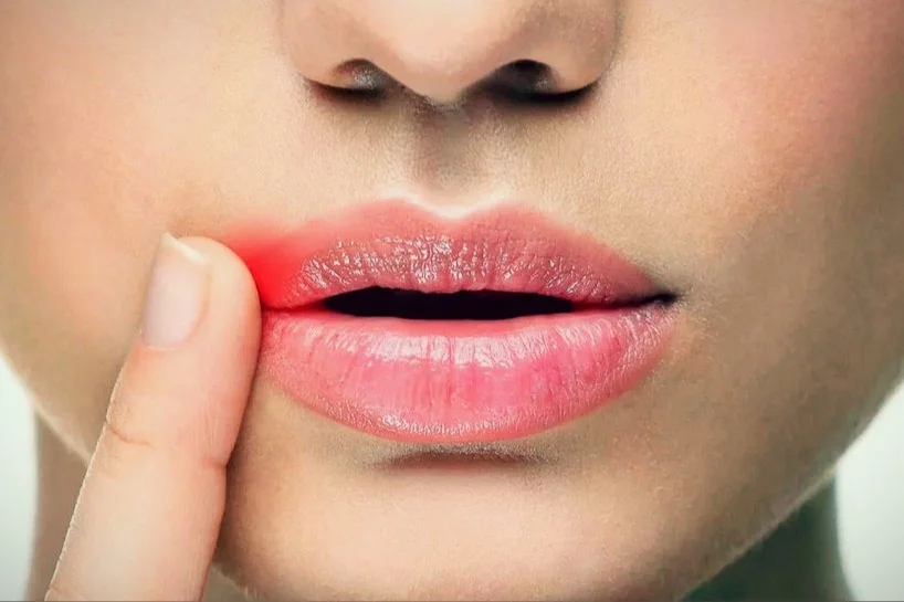 Заеды в уголках рта. Причины. Профилактика