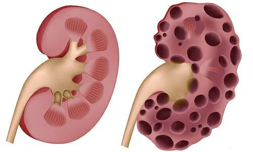 Влияние алкоголя на почки
