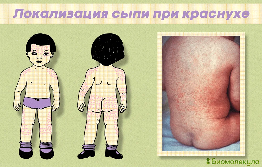 Лечение краснухи