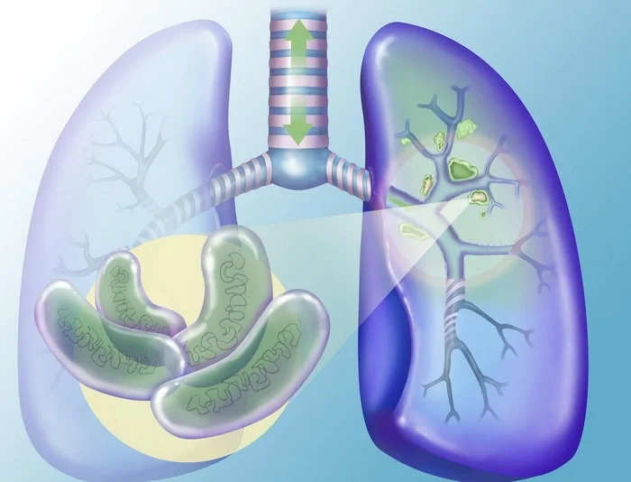 «Профилактика туберкулеза»