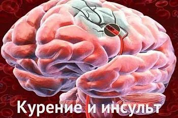 Курение и инсульт Курение и инсульт