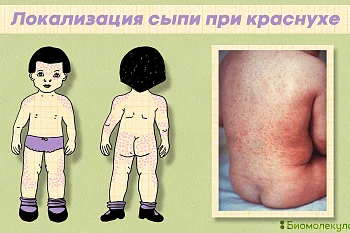 Лечение краснухи