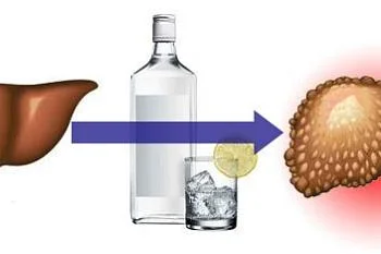  Алкогольная болезнь печени