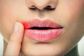 Заеды в уголках рта. Причины. Профилактика Заеды в уголках рта. Причины. Профилактика