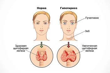 Пост на тему: «Как проявляется гипотиреоз у взрослого человека».