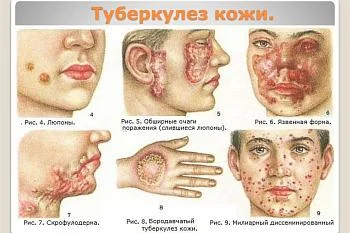 ТУБЕРКУЛЕЗ КОЖИ. ЧТО ЭТО?