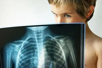 Какие первые проявления туберкулёза у детей.