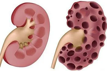 Влияние алкоголя на почки
