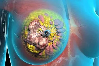 Статья: «Рак молочной железы»