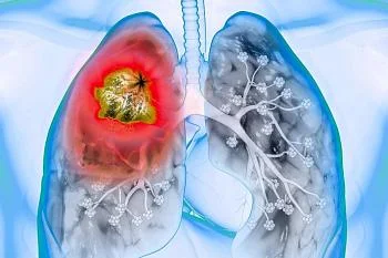 Факторы риска развития рака легких