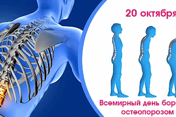 Всемирный день борьбы с остеопорозом