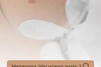 Меланома. Что нужно знать ? Меланома. Что нужно знать ?