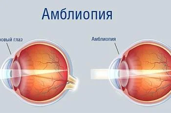 Табачная амблиопия - слепота от табака