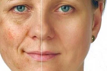 Почему алкоголь — враг для красоты кожи лица?