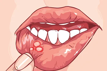 Стоматит Стоматит