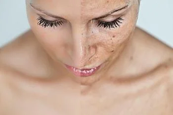 КАК БОРОТЬСЯ С ГИПЕРПИГМЕНТАЦИЕЙ