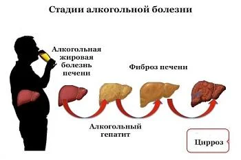 Алкогольный токсический гепатит