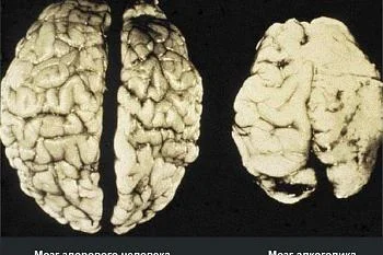 Алкогольная деменция.