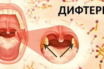 Чем опасна дифтерия?