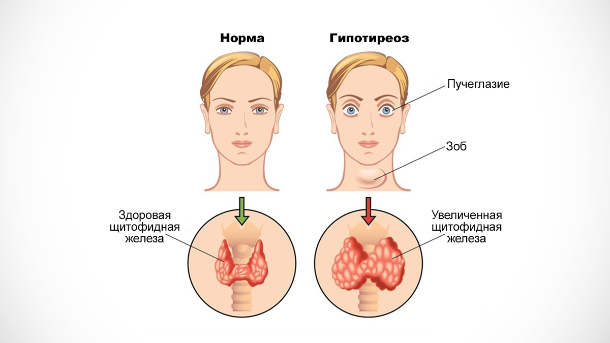 Гипотиреоз причины симптомы. Гипотиреоз щитовидной железы фото. Гипотиреоз частота заболеваний.
