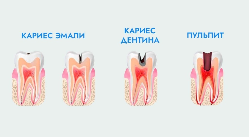  Коварство кариеса