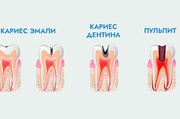 Коварство кариеса Коварство кариеса