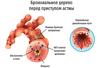 ВТОРИЧНАЯ ПРОФИЛАКТИКА БРОНХИАЛЬНОЙ АСТМЫ.